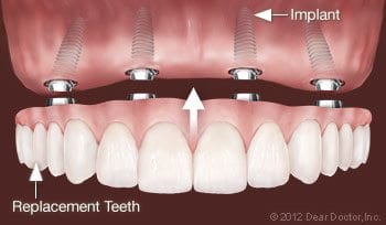 all-on-four Dentures and Partials