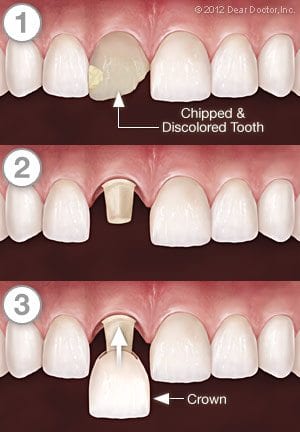 dental crown procedure at Ellicott MD dentist