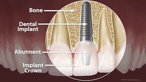 dental implants in Columbia Maryland