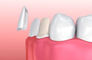 Affordable Dental Veneers in Columbia MD
