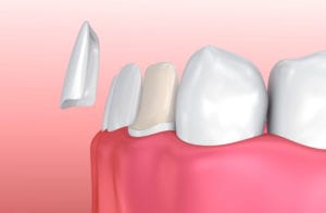 Affordable Dental Veneers in Columbia MD