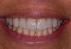 After cosmetic dentistry in Columbia Maryland