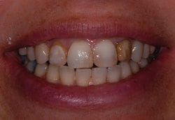 Before cosmetic dentistry in Columbia Maryland