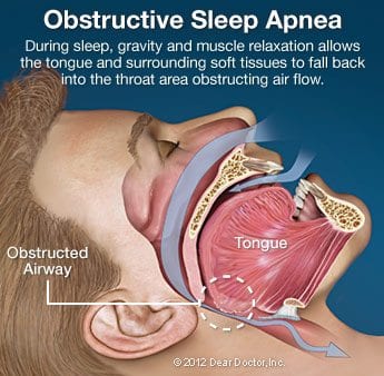 Sleep Apnea program at Howard County Smiles