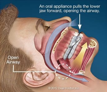 Snoring & Sleep Apnea treatment in Howard County