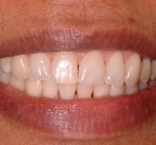 After cosmetic dentistry in Columbia Maryland