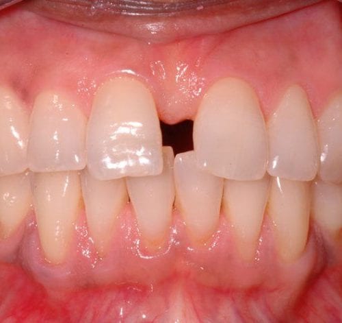 Before cosmetic dentistry in Columbia Maryland