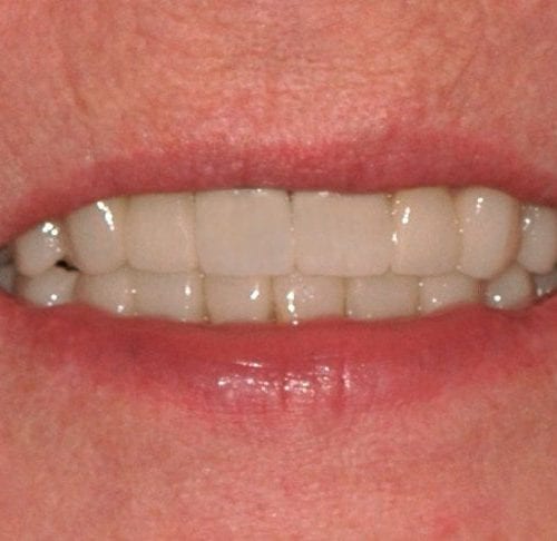 After cosmetic dentistry in Columbia Maryland