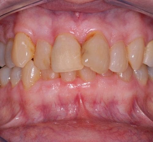 Before cosmetic dentistry in Columbia Maryland