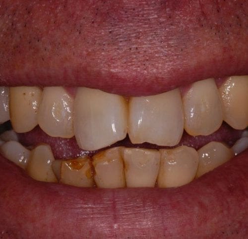 Before cosmetic dentistry in Columbia Maryland