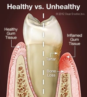 periodontal disease treatment in Columbia MD