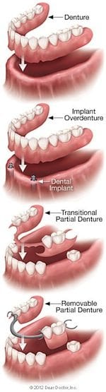 removable denture types