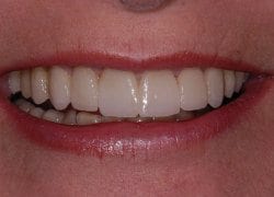 After cosmetic dentistry in Columbia Maryland