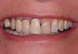 Before cosmetic dentistry in Columbia Maryland