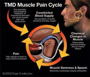 TMD Muscle Pain Cycle