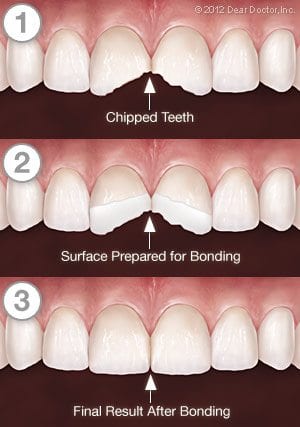 tooth bonding series diagram