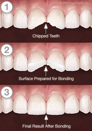 affordable teeth bonding near me