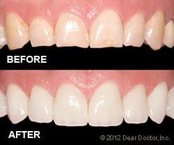 dental veneers before and after