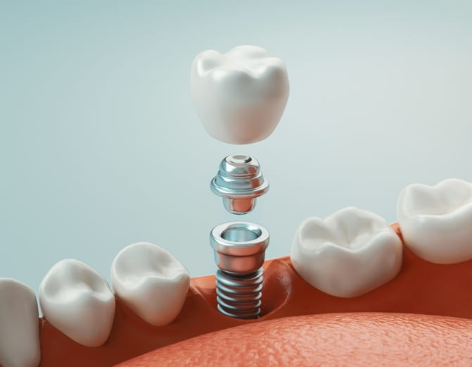 affordable dental implants in Columbia, MD