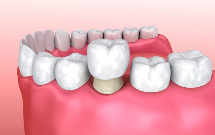 Dental Crowns in Columbia, Maryland