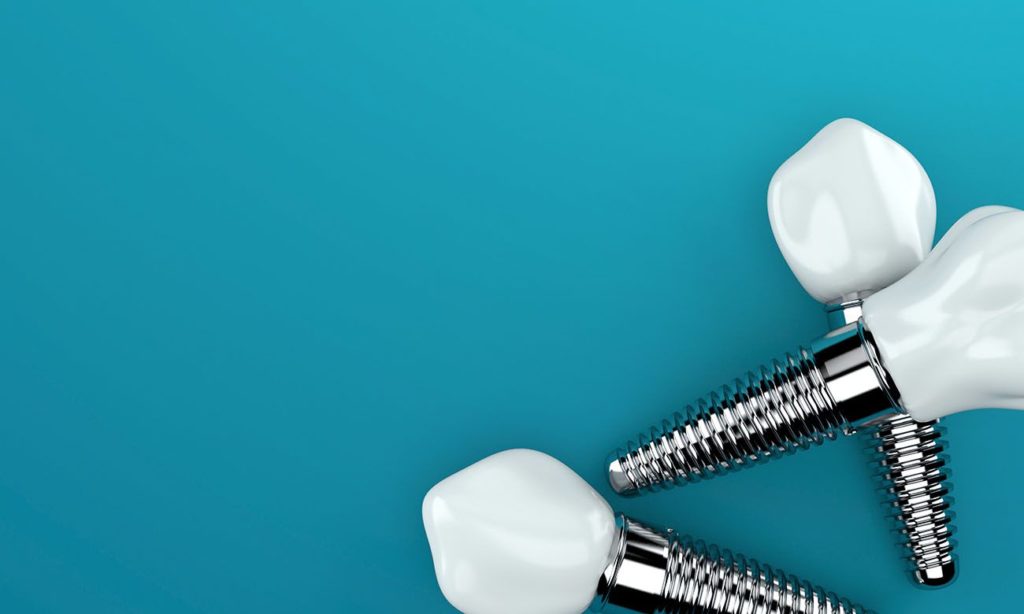 single dental implants