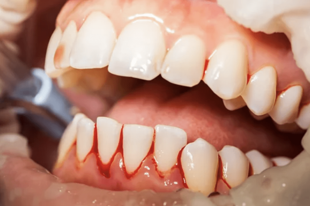 closeup of bleeding gums during dental procedure gum disease dentists in Columbia Maryland
