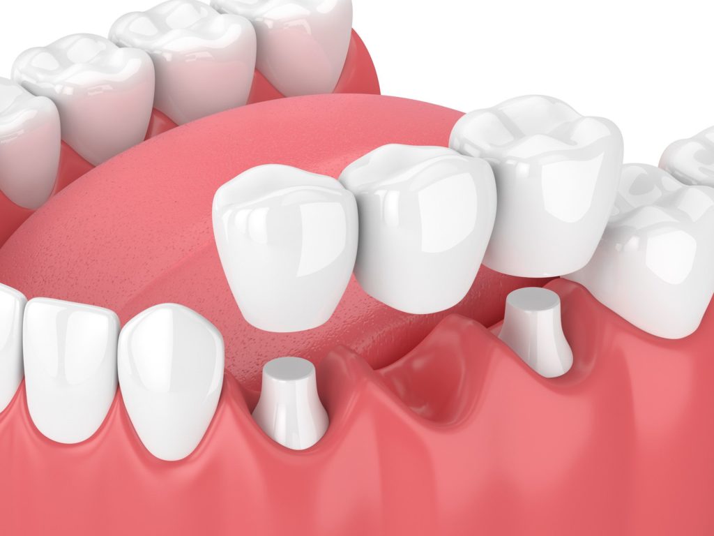 3d render of jaw with dental bridge over white background dentist in Columbia Maryland
