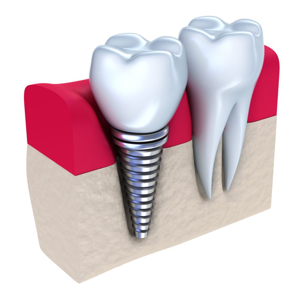 The Benefits of Dental Implants in Columbia, MD