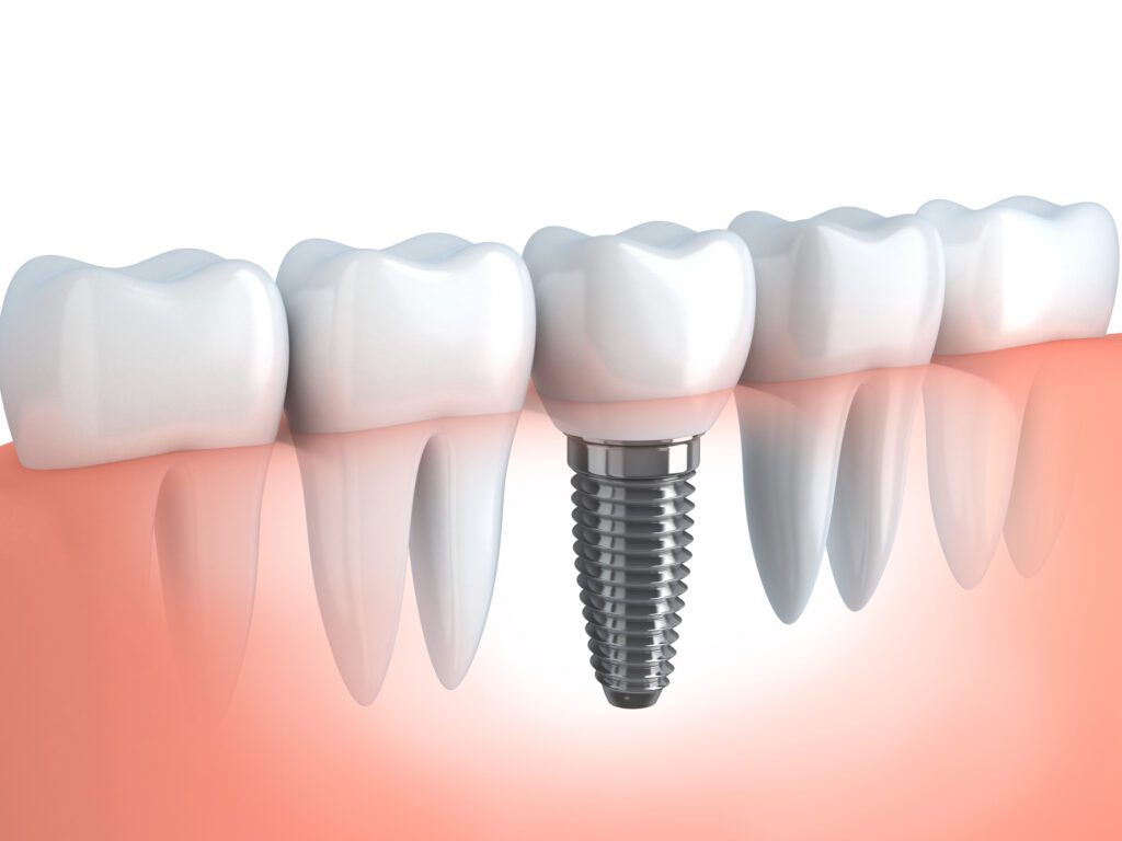 implant-supported crown in Columbia, MD