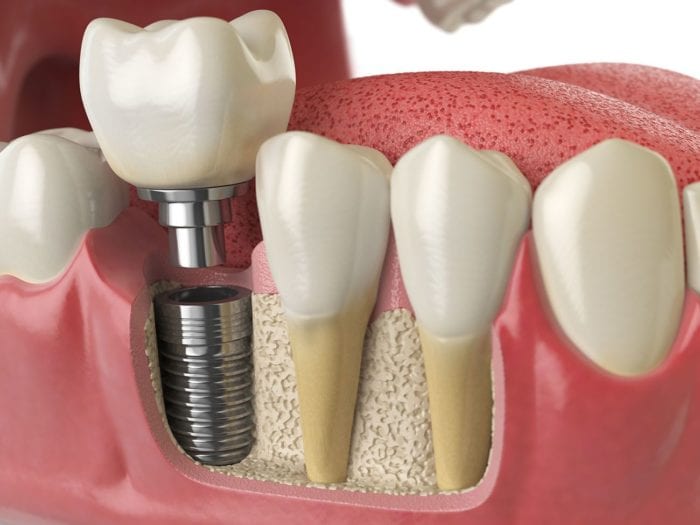 The cost of dental implants in Columbia, MD