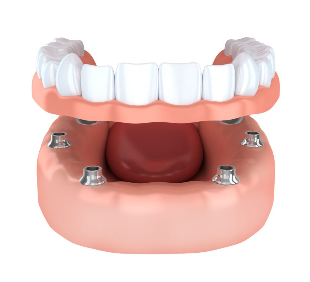 full mouth dental implants in Columbia, MD
