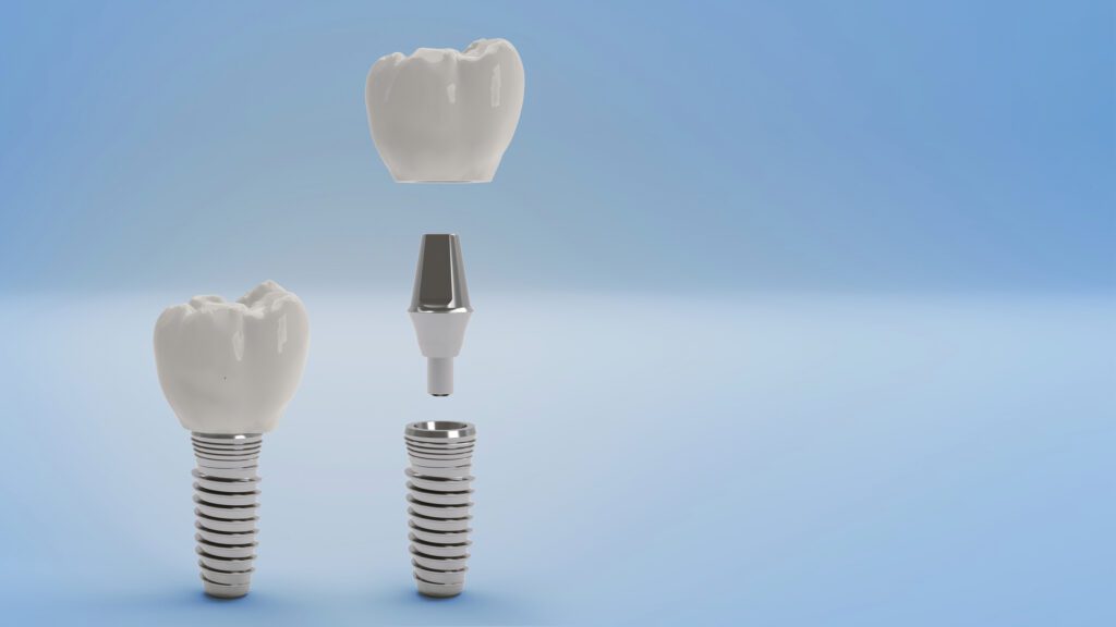 Dental Implants FAQs in Columbia MD
