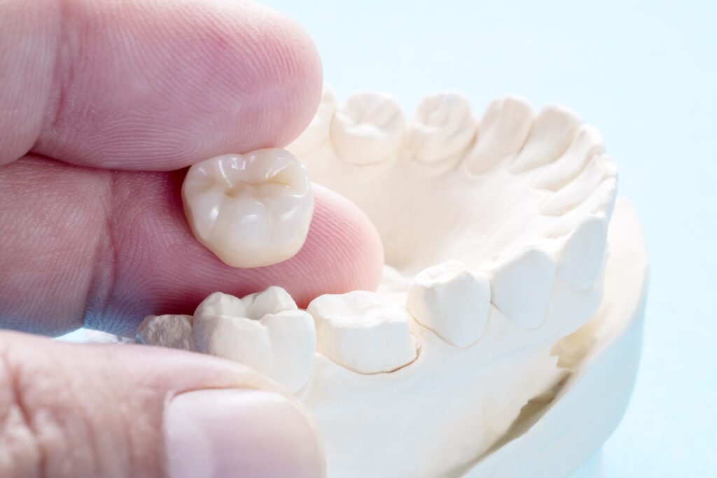 CEREC in Columbia MD